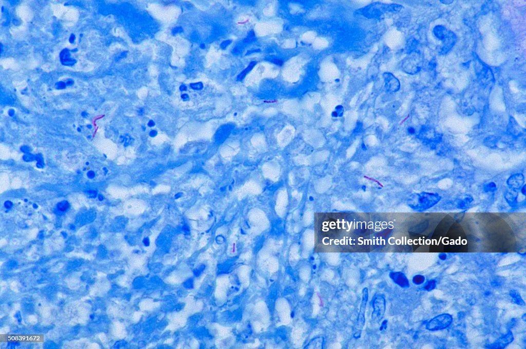 Histopathology Of Tuberculosis