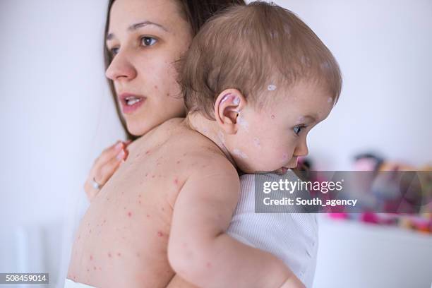 mother taking care of baby with chicken pox - red tub stock pictures, royalty-free photos & images