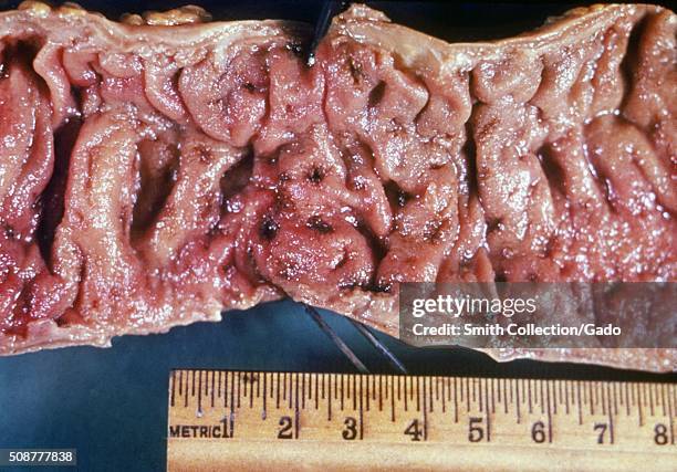 Gross pathology of intestinal ulcers due to amebiasis. Image courtesy CDC/Dr. Mae Melvin, Dr. E. West of Mobile, AL, 1962. .