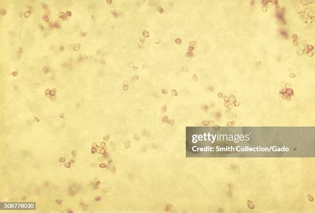Yeast forms of Histoplasma capsulatum in tissue. Histopathology of histoplasmosis showing yeast forms of Histoplasma capsulatum . This fungus shows...