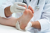 Tinia pedis or Athlete's foot