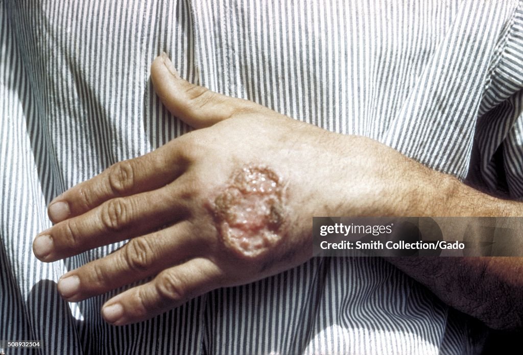 Skin ulcer due to leishmaniasis