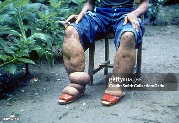 Elephantiasis of leg due to filariasis. Luzon, Philippines. Image courtesy CDC, 1962. .