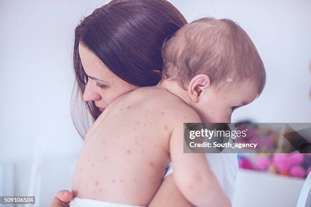 mother taking care of baby with chicken pox - pokken huidaandoening stockfoto's en -beelden