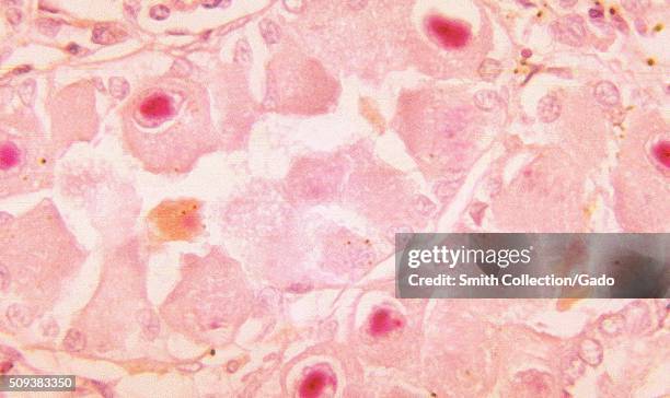 Histopathology of cytomegalovirus infection of kidney tubule epithelial cells, Lendrum stain Image courtesy CDC/Dr Haraszti, 1964. .