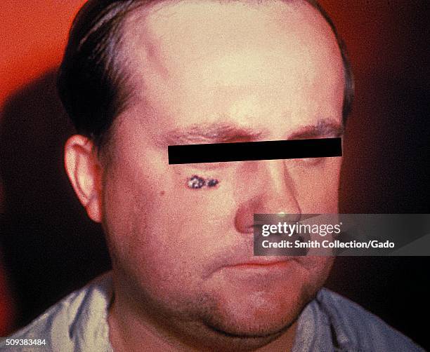 Anthrax skin lesion on face of man. Cutaneous. Image courtesy CDC, 1974. .