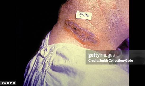 Anthrax skin lesion on neck of man. Cutaneous. Image courtesy CDC, 1974. .