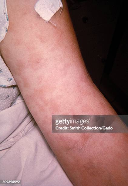 Penicillin Skin Photos And Premium High Res Pictures Getty Images