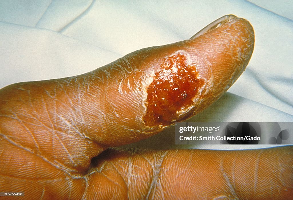 Thumb With Skin Ulcer