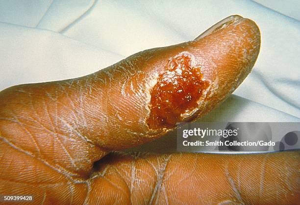 Thumb with skin ulcer of tularemia. Image courtesy CDC/Emory Univ. Dr. Sellers, 1964. .