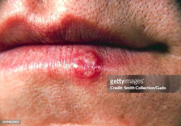 This is a close-up of the lip of patient with a herpes simplex lesion on the lower lip due to the pathogen. Herpes simplex virus type 1 usually is...