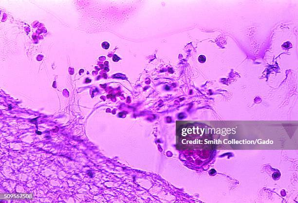 Mild meningitis with hemorrhage due to Bacillus anthracis. Photomicrograph of mild meningitis along with hemorrhage, and the presence of Bacillus...