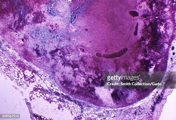 Severe hemorrhagic necrosis of lymph node due to anthrax. Photomicrograph of mediastinal lymph node from a Cynomolgus monkey, Macaca fascicularis,...
