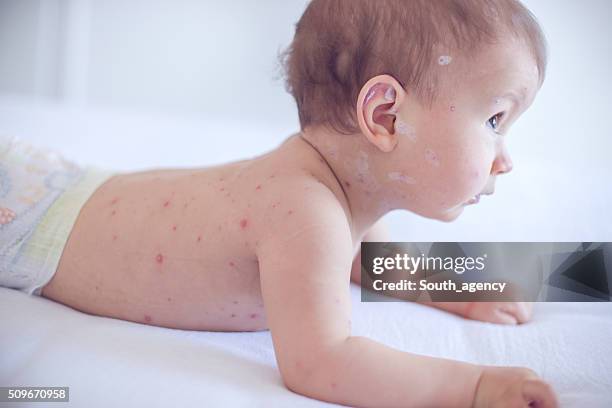 niña bebé con varicela - varicela fotografías e imágenes de stock