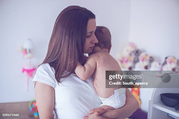 mother taking care of baby with chicken pox - clear skin red background stock pictures, royalty-free photos & images