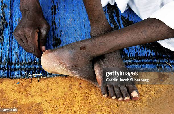 Man paralyzed by polio sits with his ankles crossed on a prayer mat May 24, 2004 in Kano, Nigeria. The polio virus often causes wasting of the lower...