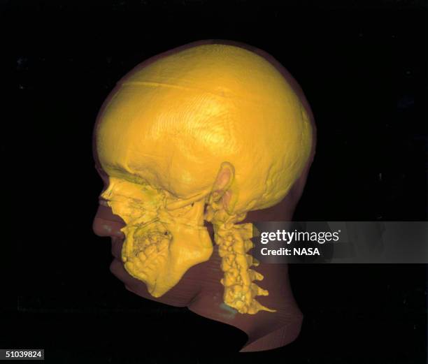 High Resolution Three-Dimensional Image Displays A Computerised Visualization Of A Boy's Head With A Loss Of Facial Skeleton Due To The Removal Of A...