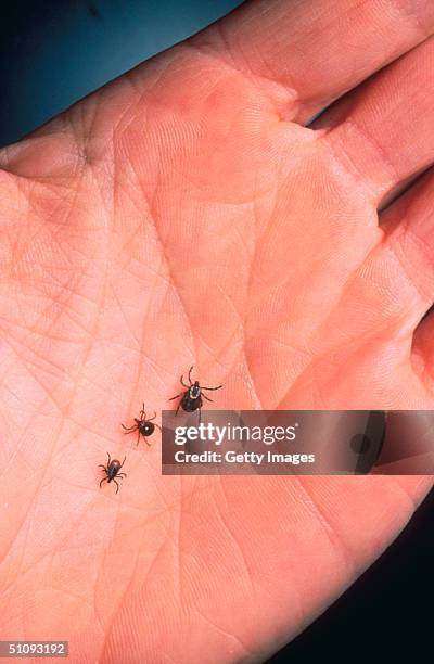 Close Up Of An Adult Female Deer Tick, Dog Tick, And A Lone Star Tick Are Shown June 15, 2001 On The Palm Of A Hand. Ticks Cause An Acute...