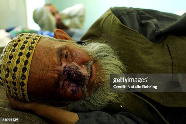 Man Suffering From Cutaneous Leishmaniasis, A Disfiguring And Disabling Skin Disease, Lies In A Hospital Bed After Receiving An Injection May 8, 2002...