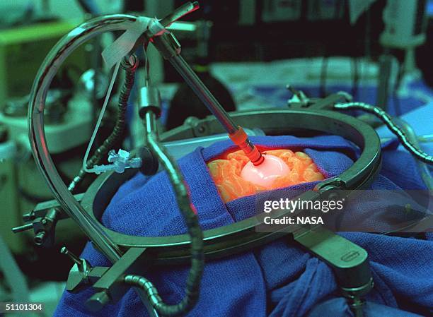 Simulation Of Surgical Implantation Of The Light Emitting Diodes Probe At The Children's Hospital Of Wisconsin, Medical College Of Wisconsin,...