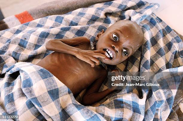 Severely malnourished child lays on a bed of the intensive care unit of the Medecins-sans-frontieres clinic December 4, 2003 in Maradi, Niger....