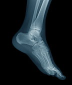 Digital X-ray image of a young foot, oblique view.
