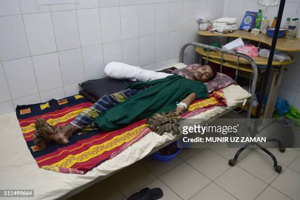 Bangladeshi man Abdul Bajander rests a day after a surgery at Dhaka Medical College Hospital in Dhaka on February 21, 2016. A Bangladeshi man dubbed...