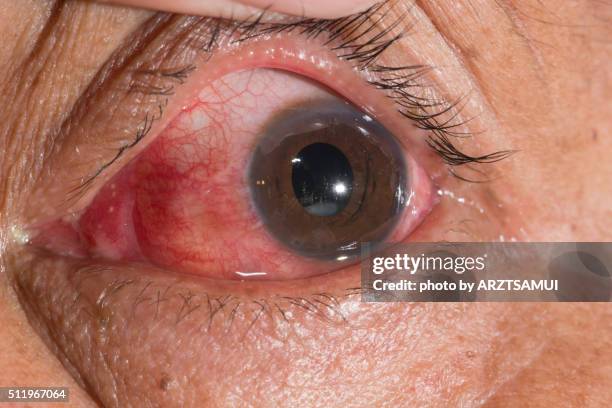 eye test - cataract eye stock pictures, royalty-free photos & images