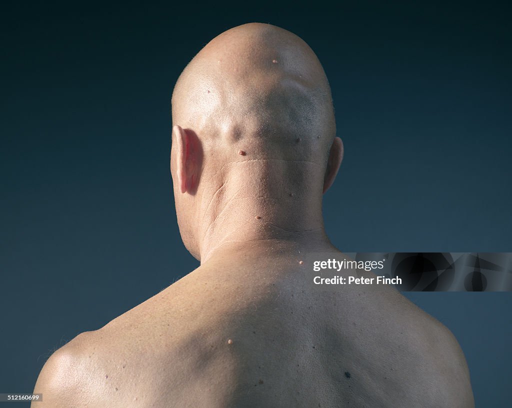 Middle-aged man's back with moles