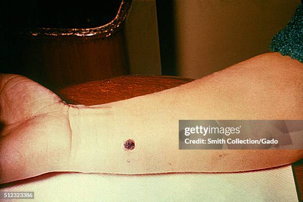 Anthrax, skin of right forearm, 12th day. 27 year old white female with cutaneous anthrax on right forearm, patient had worked in a spinning...