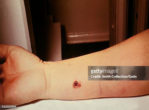 Anthrax, skin of right forearm, 7th day. 27 year old white female with cutaneous anthrax on right forearm, patient had worked in a spinning...