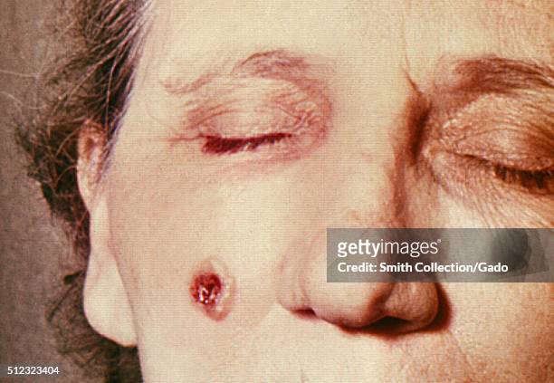 Anthrax, skin of face, 5th day. 53 year old female, employed 10 years in the spinning department of a goat-hair processing mill. Cutaneous anthrax...