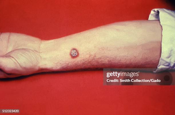 Anthrax, skin of left forearm. Cutaneous anthrax lesion on left forearm of a white male. Image courtesy CDC. 1990. .