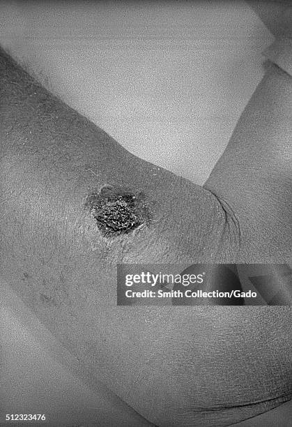 Cutaneous anthrax, lesion on the left forearm. Cutaneous anthrax on the skin of the left forearm. Image courtesy CDC/J. Steele, 1962. .