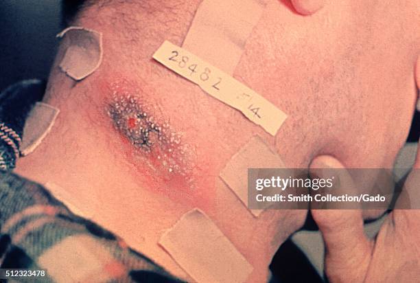 Cutaneous anthrax lesion on neck of man. Image courtesy CDC. 1990. .