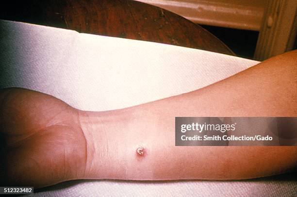 Anthrax, skin of right forearm, 4th day. 27 year old white female with cutaneous anthrax on right forearm, she'd worked in a spinning department of a...