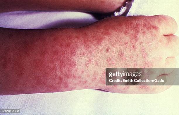 Child's right hand and wrist displaying the characteristic spotted rash of Rocky Mountain spotted fever. Rocky Mountain spotted fever is the most...
