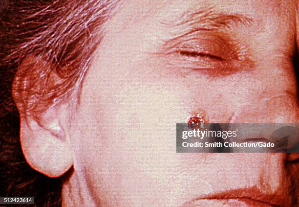 Anthrax, skin of face, 8th day. 53 year old female, employed 10 years in the spinning department of a goat-hair processing mill. Cutaneous anthrax...