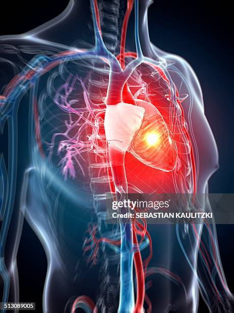 ilustraciones, imágenes clip art, dibujos animados e iconos de stock de human heart attack, artwork - sistema-cardiopulmonar-humano