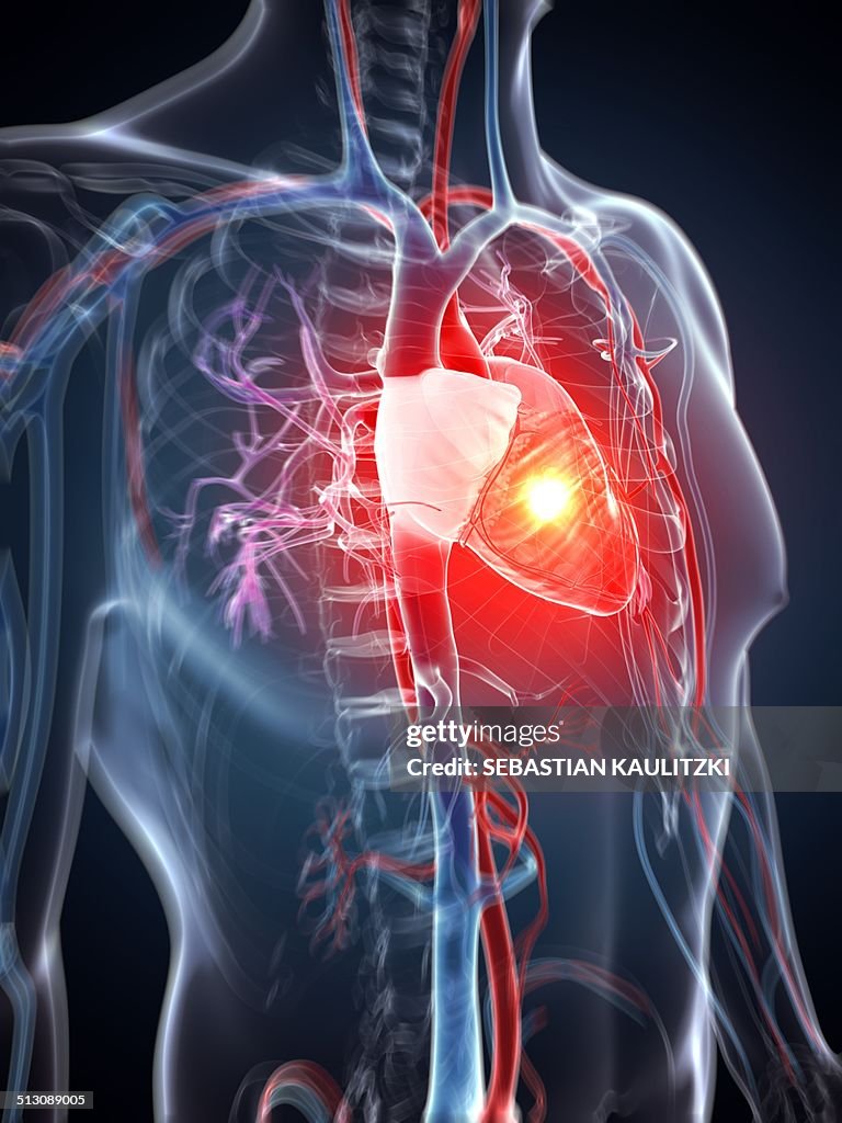 Human heart attack, artwork