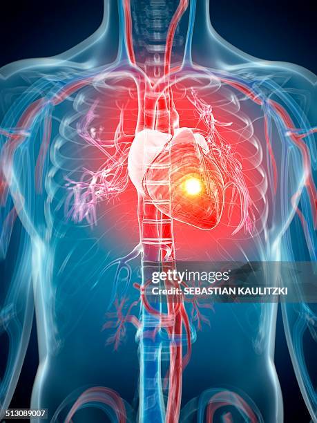 ilustrações, clipart, desenhos animados e ícones de human heart attack, artwork - sistema circulatorio