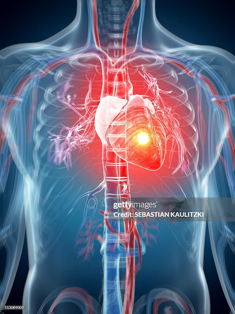 Human Attack Human Heart Attack Artwork High-Res Vector Graphic - Getty Images