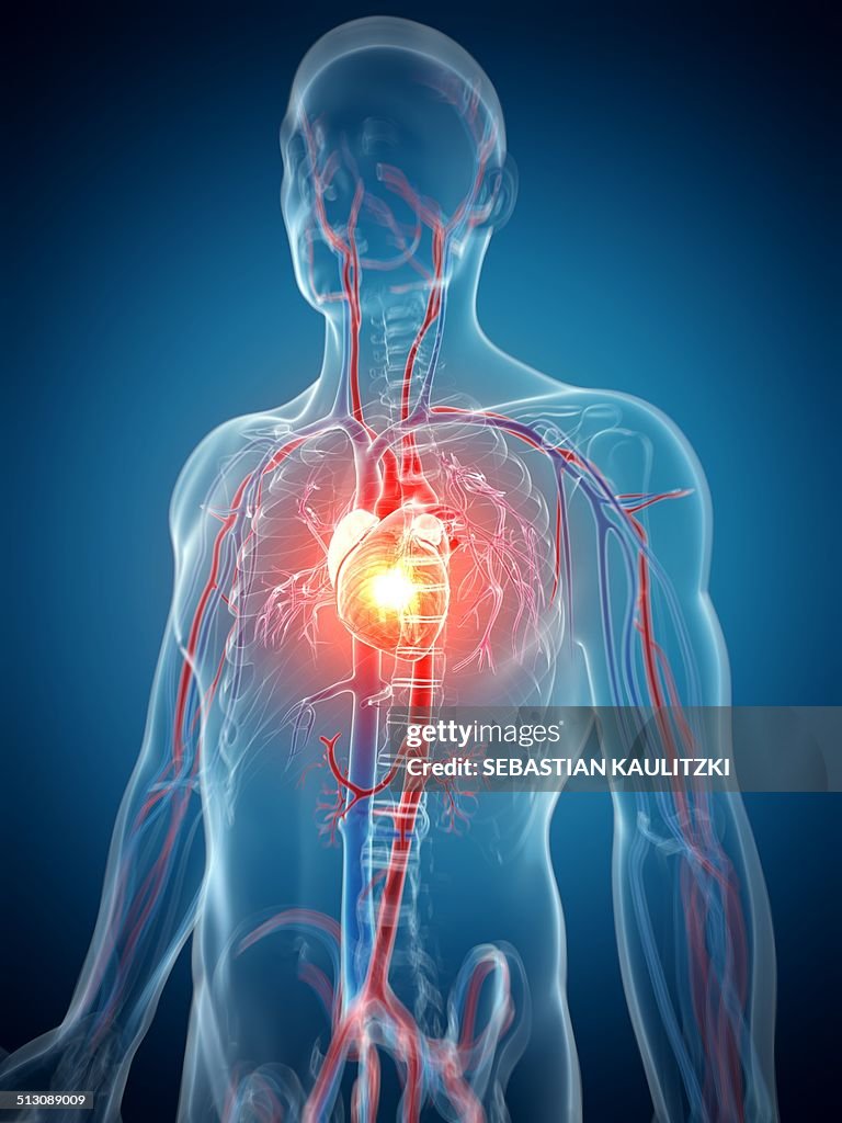 Human heart attack, artwork