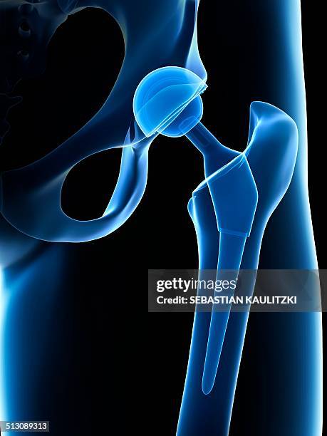 human hip replacement, artwork - hip replacement stock illustrations