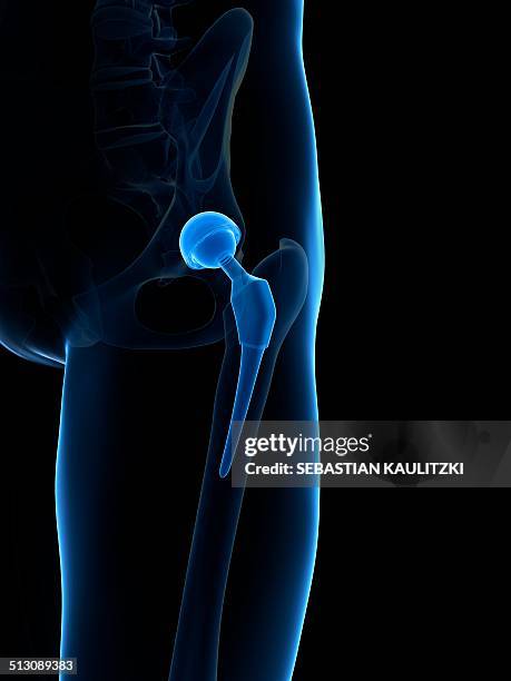 ilustrações, clipart, desenhos animados e ícones de human hip replacement, artwork - bacia artificial