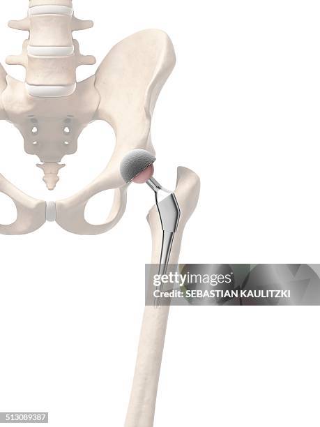 human hip replacement, artwork - hip replacement stock illustrations