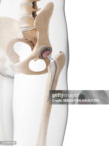 human hip replacement, artwork - künstliches hüftgelenk stock-grafiken, -clipart, -cartoons und -symbole