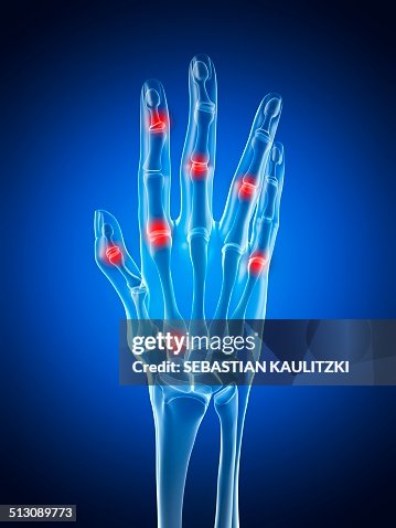 Arthritic hand, artwork Arthritic hand, artwork