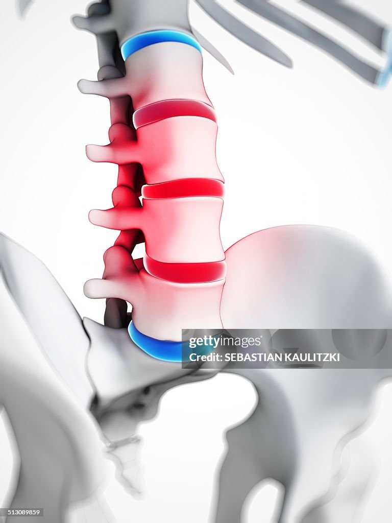 Slipped disc, artwork