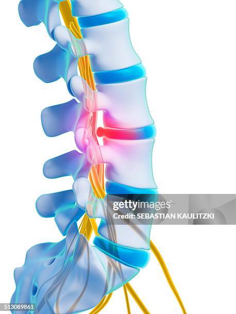 slipped disc, artwork - bandscheibenvorfall stock-grafiken, -clipart, -cartoons und -symbole